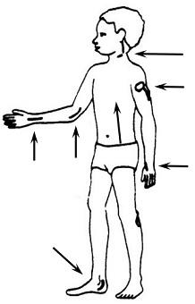 A boy with leprosy. The illustration shows where to check for thick, swollen nerves. Arrows point to the back of the neck, the wrist, the elbow, the back of the upper arm, the ankle, and behind the knee