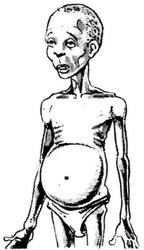 Un enfant maigre et mal nourri avec un ventre gonflé, des joues enfoncées et des cheveux tachetés et décolorés