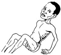 Un enfant maigre et mal nourri. Ses bras et ses jambes sont très fins, ses côtes sont bien visibles et ses joues sont enfoncées.