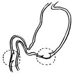 Schéma de l’estomac et des intestins, montrant la peau abîmée sur la face intérieure