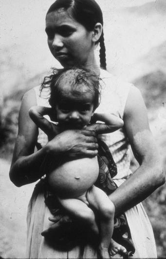  Une jeune mère tenant dans ses bras son bébé mal nourri. La mère a des taches blanches sur les bras. Les cheveux du bébé sont fins et broussailleux et son ventre est gonflé, mais ses bras et ses jambes sont très fins.